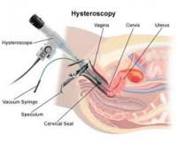article-ysteroskophsh-2b187da0